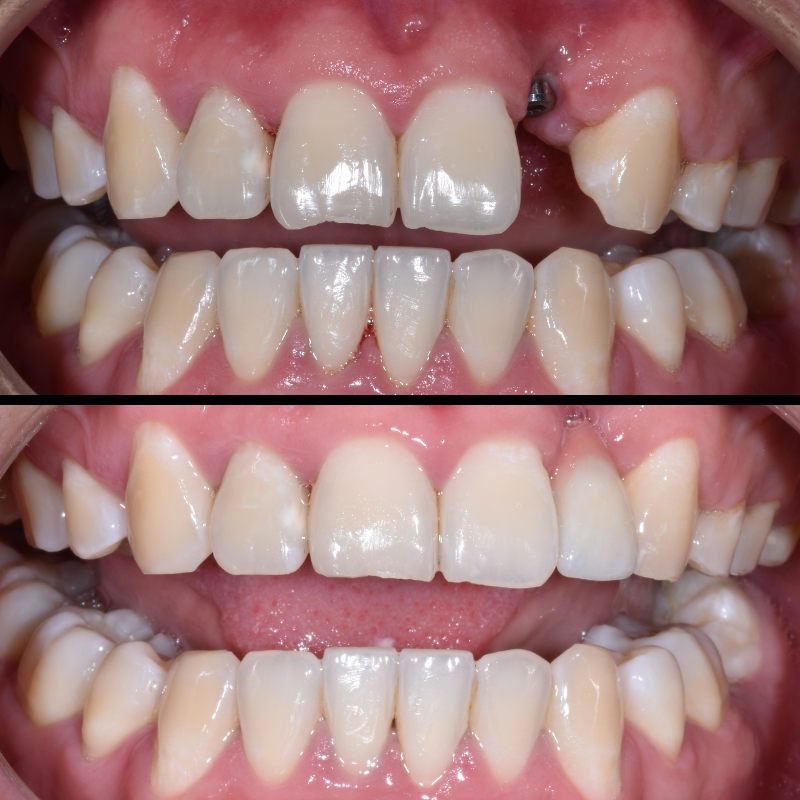 Dental Implants