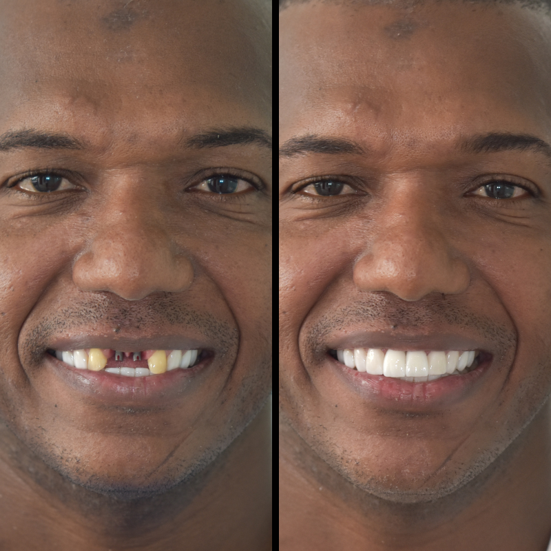 Dental Implants