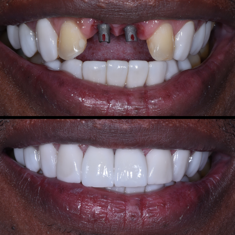Dental Implants