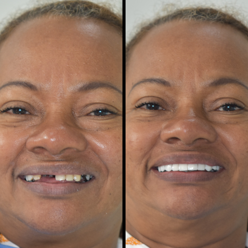 Dental Implants