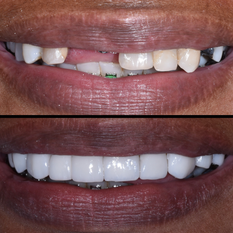 Dental Implants