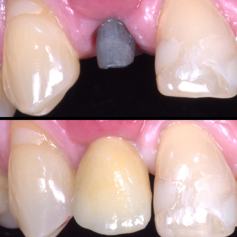 Dental Implants