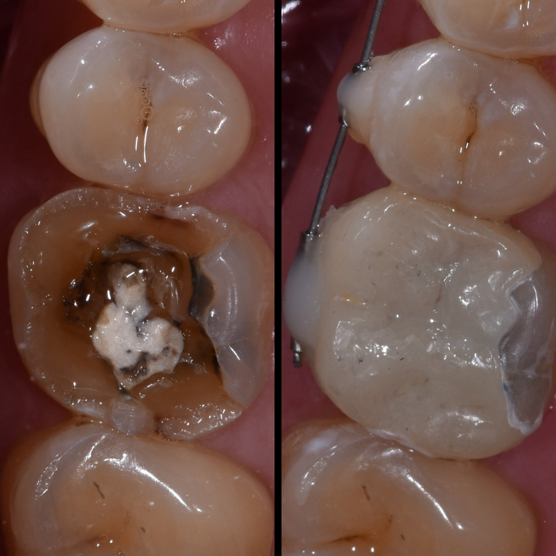 Dental Bridges and dental Crowns