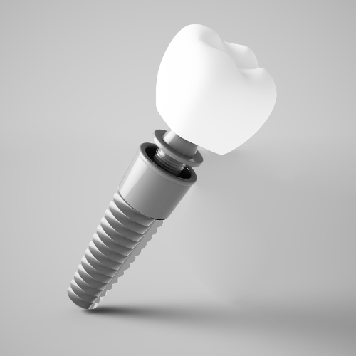 Dental Implants