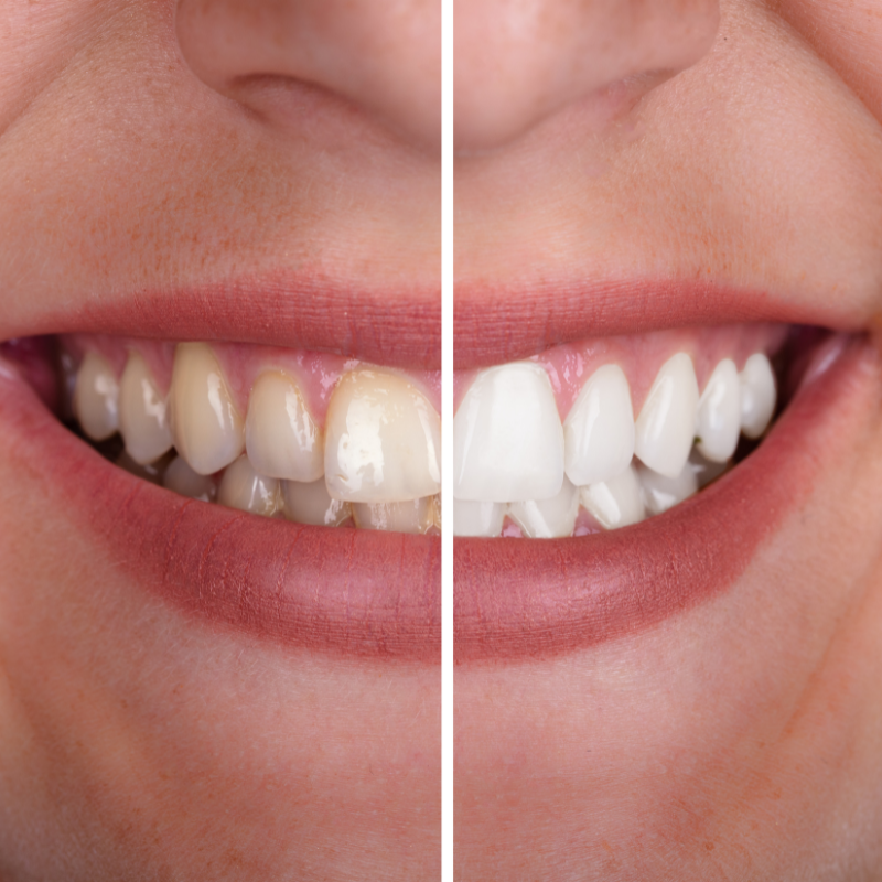 Teeth Whitening