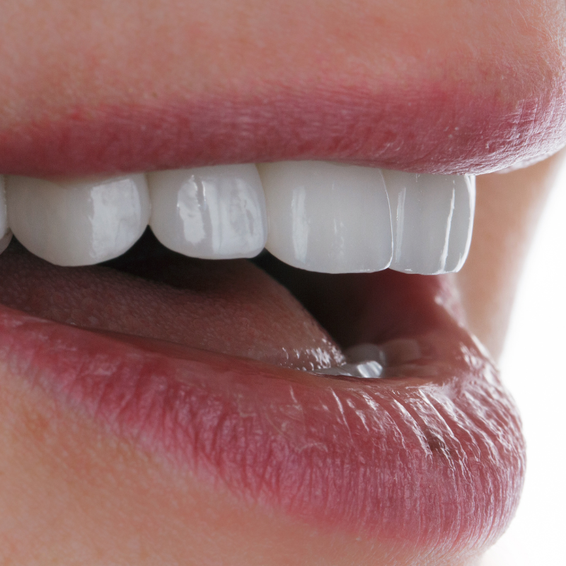 Smile Design (Composite Veneers)
