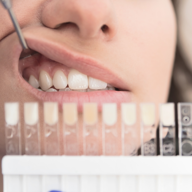 Teeth Whitening