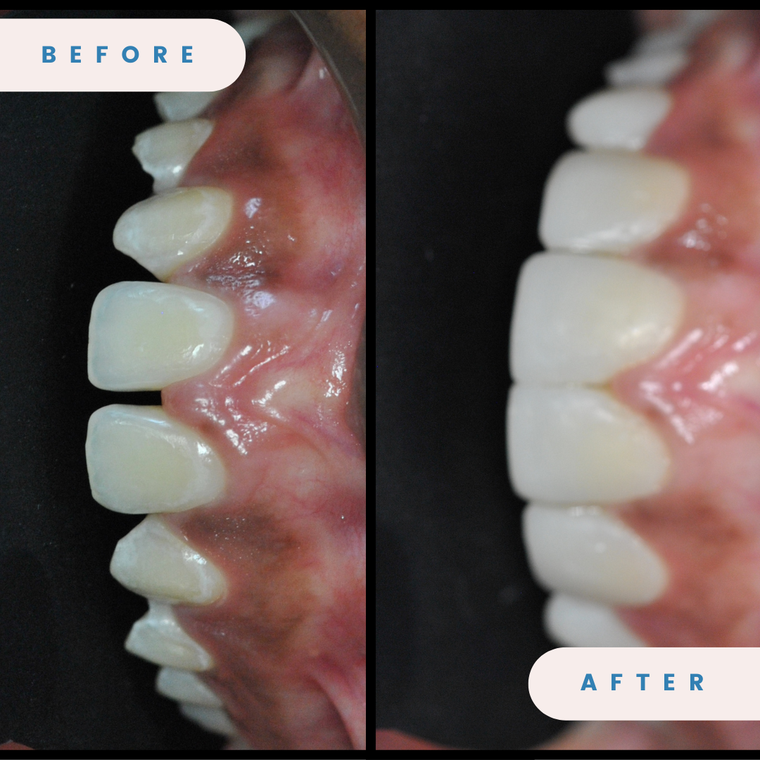 Smile Design (Composite Veneers)