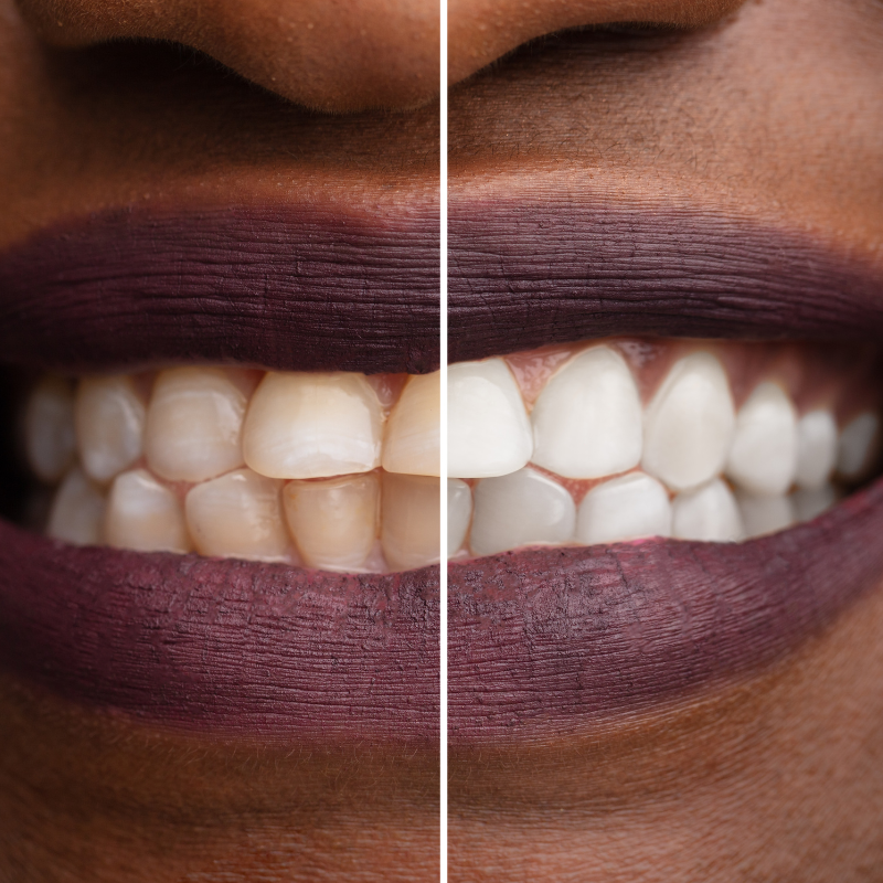 Teeth Whitening