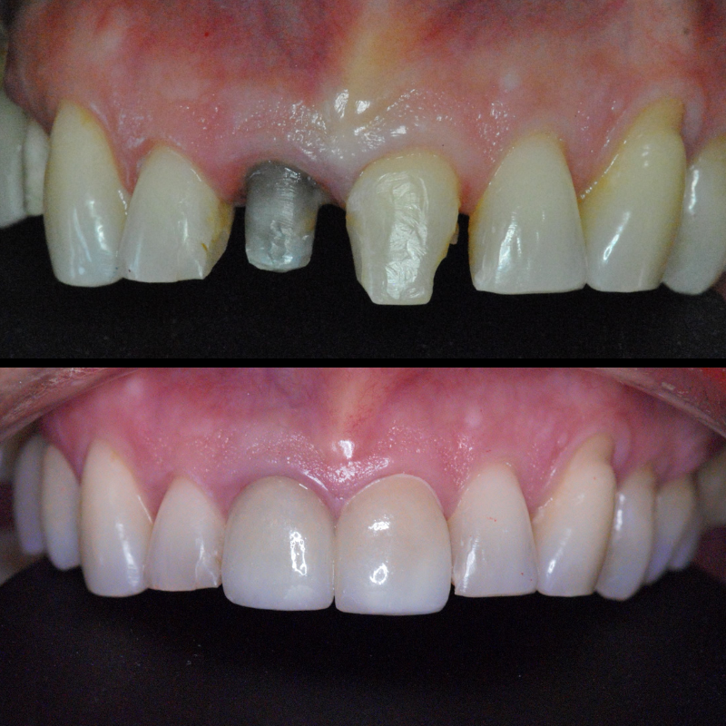Dental Bridges and dental Crowns