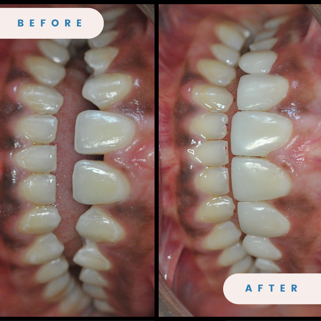 Smile Design (Composite Veneers)