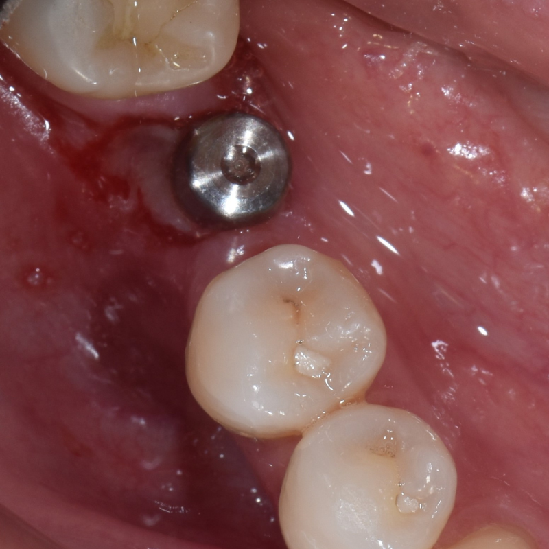 Dental Implants
