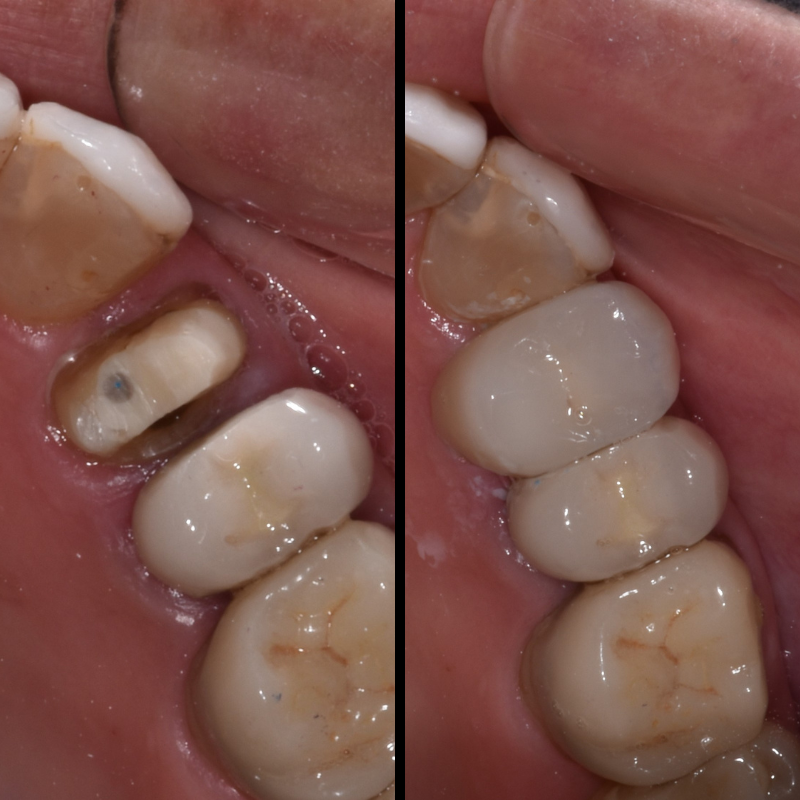 Dental Bridges and dental Crowns