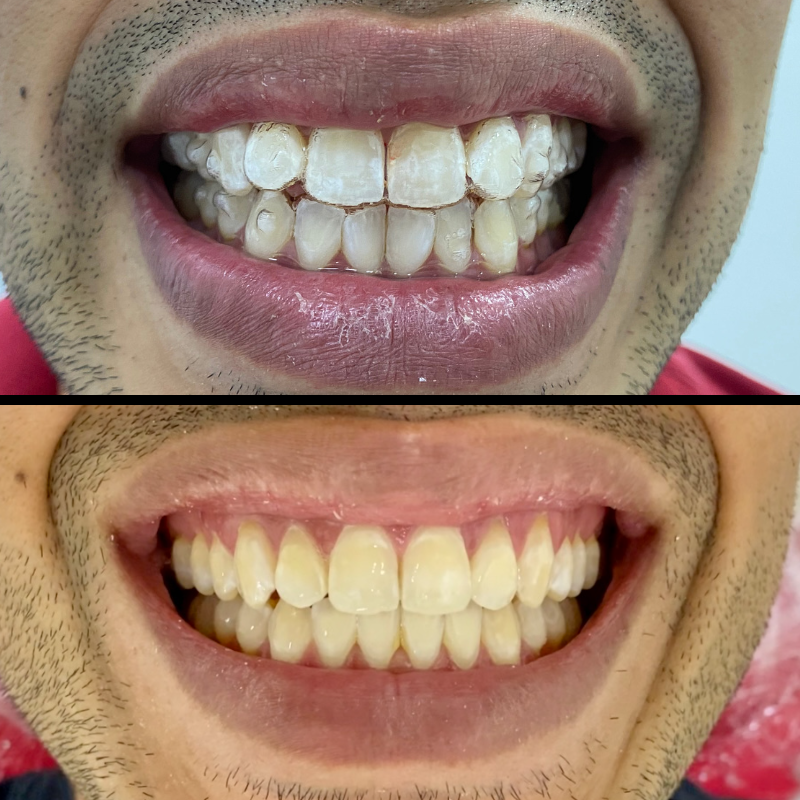 Invisalign®