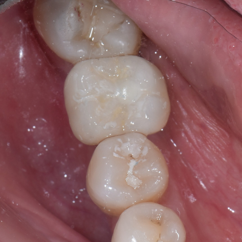Dental Implants