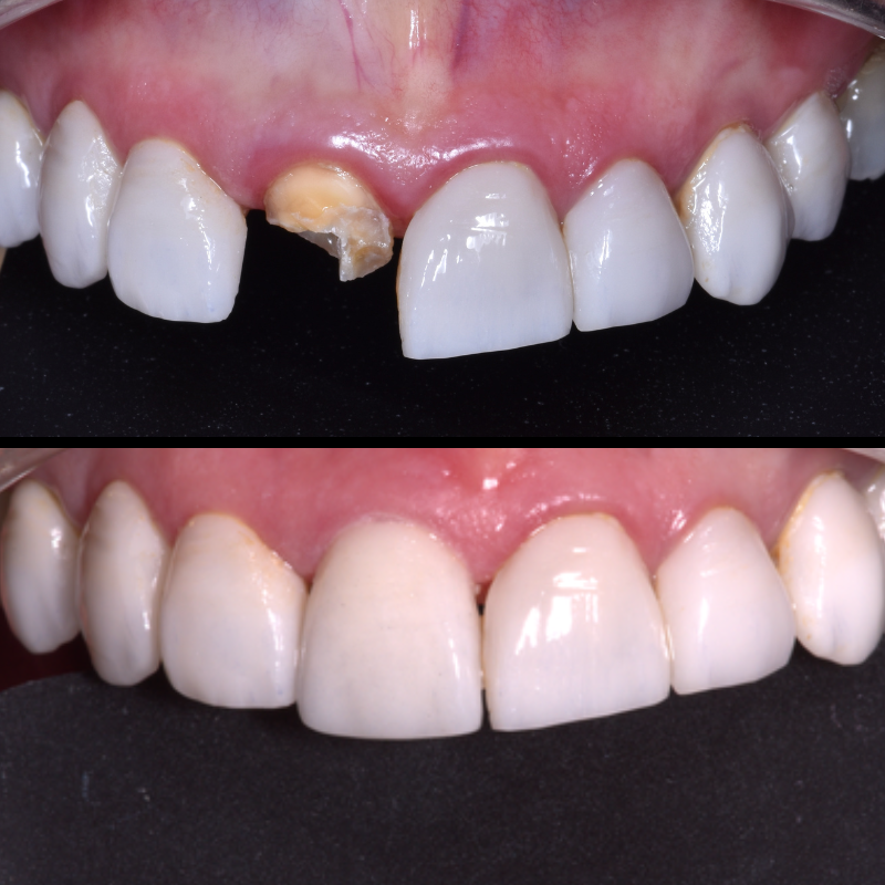 Dental Bridges and dental Crowns