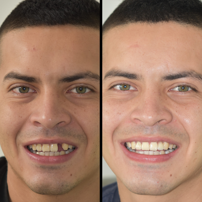 Dental Implants