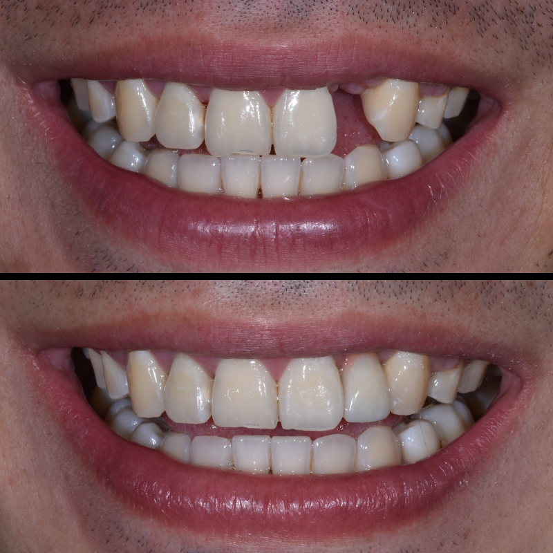 Dental Implants