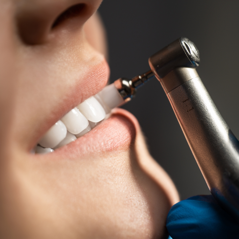 Dental Deep cleaning