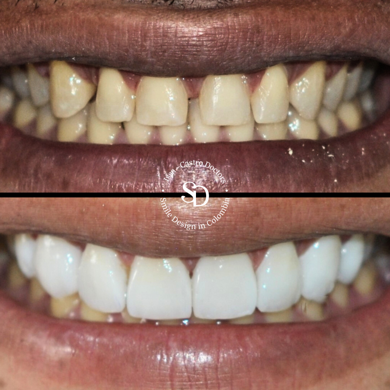 Porcelain Veneers in colombia | smile design by doctor Issa Castro Doctors | dental tourism in cali colombia |Porcelain Veneers by Issa castro doctors