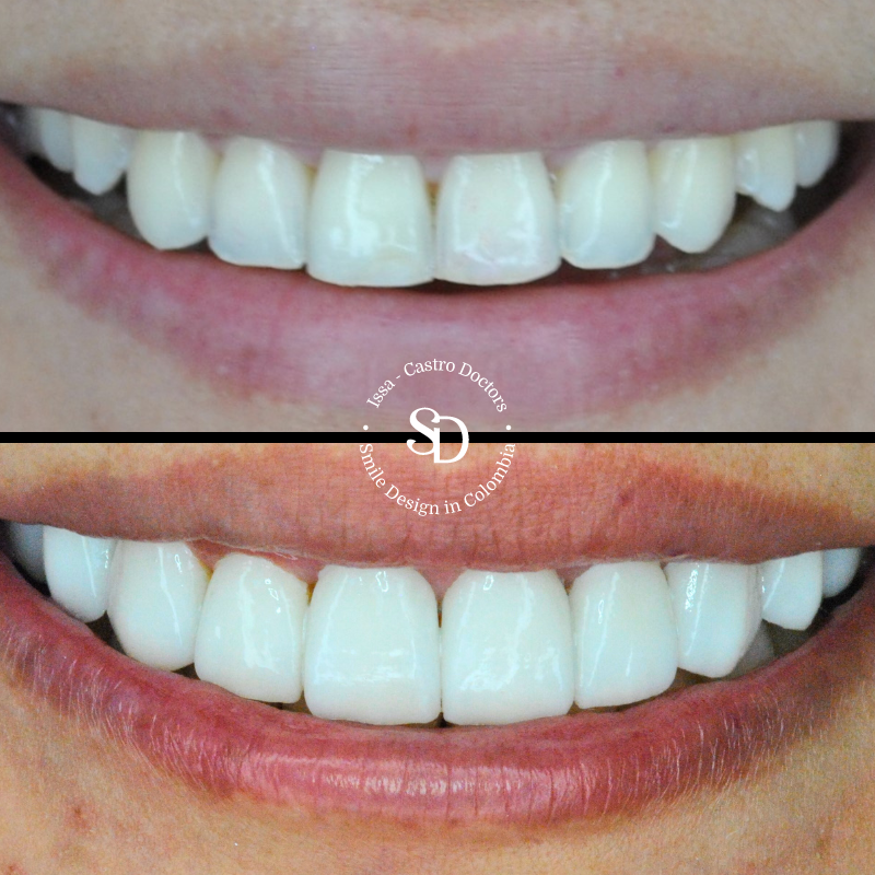 Porcelain Veneers in colombia | smile design by doctor Issa Castro Doctors | dental tourism in cali colombia |Porcelain Veneers by Issa castro doctors