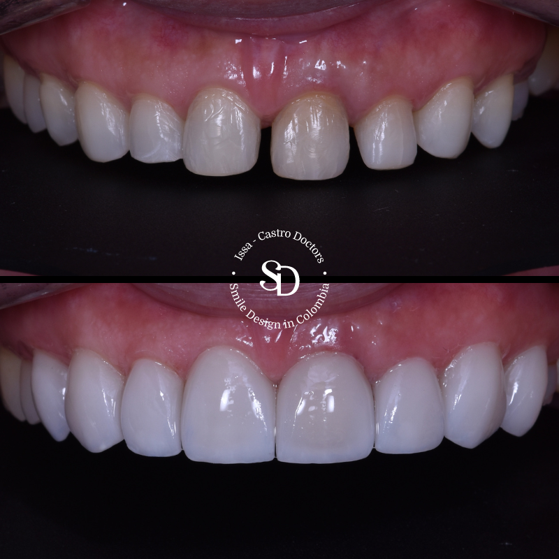 Porcelain Veneers in colombia | smile design by doctor Issa Castro Doctors | dental tourism in cali colombia |Porcelain Veneers by Issa castro doctors