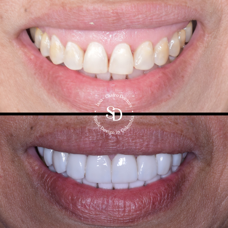 Porcelain Veneers in colombia | smile design by doctor Issa Castro Doctors | dental tourism in cali colombia |Porcelain Veneers by Issa castro doctors