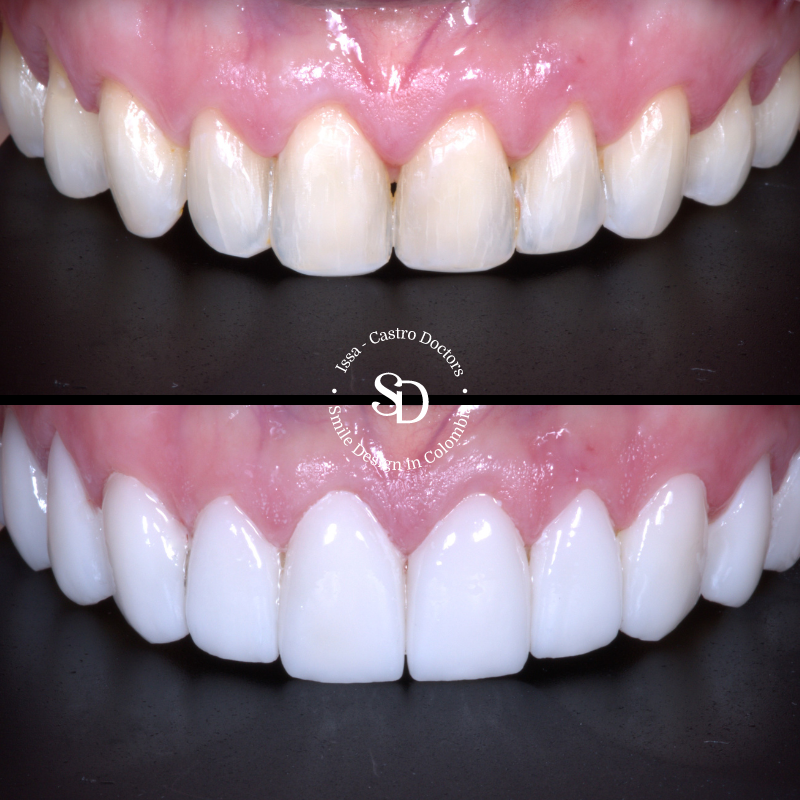 Porcelain Veneers in colombia | smile design by doctor Issa Castro Doctors | dental tourism in cali colombia |Porcelain Veneers by Issa castro doctors