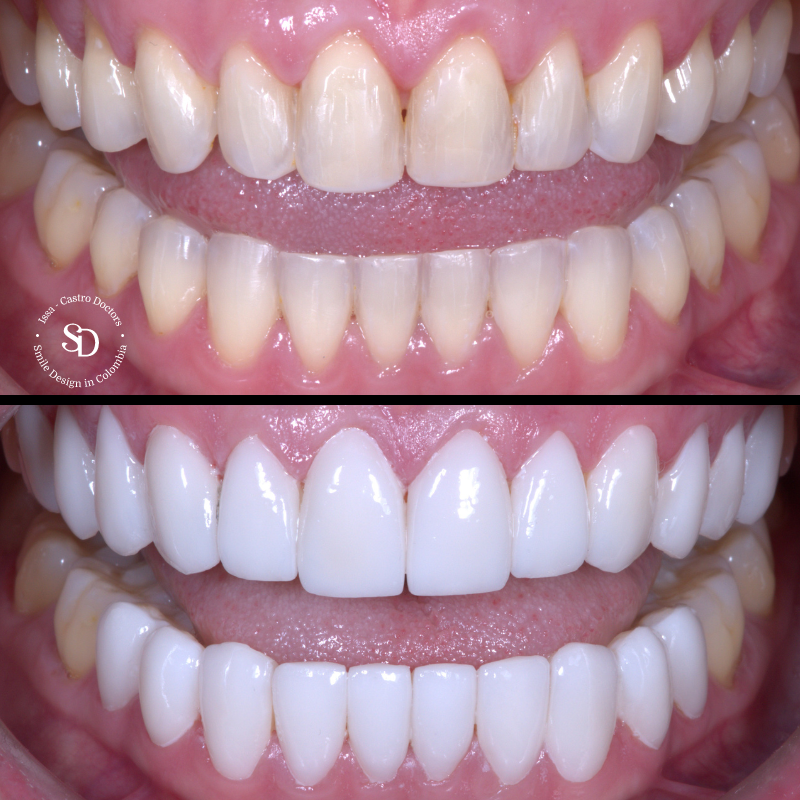 Porcelain Veneers in colombia | smile design by doctor Issa Castro Doctors | dental tourism in cali colombia |Porcelain Veneers by Issa castro doctors