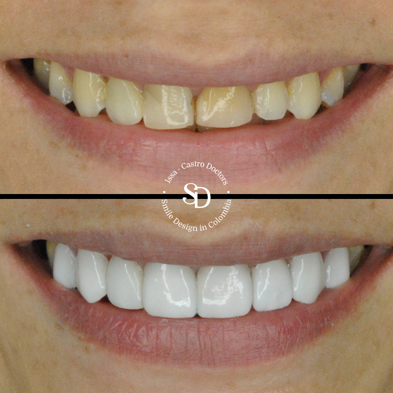 Porcelain Veneers in colombia | smile design by doctor Issa Castro Doctors | dental tourism in cali colombia |Porcelain Veneers by Issa castro doctors