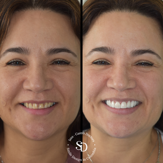 Porcelain Veneers in colombia | smile design by doctor Issa Castro Doctors | dental tourism in cali colombia |Porcelain Veneers by Issa castro doctors