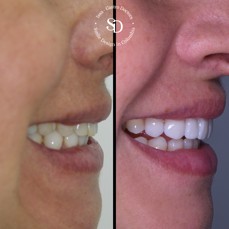 Porcelain Veneers in colombia | smile design by doctor Issa Castro Doctors | dental tourism in cali colombia |Porcelain Veneers by Issa castro doctors