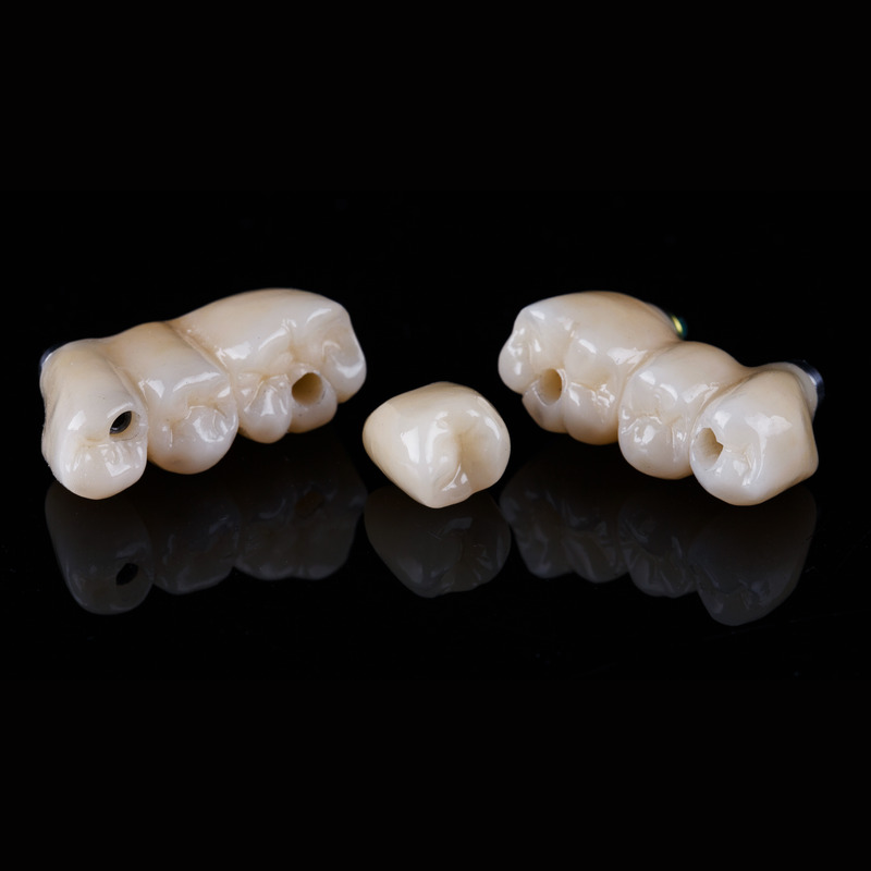 Dental Bridges and dental Crowns