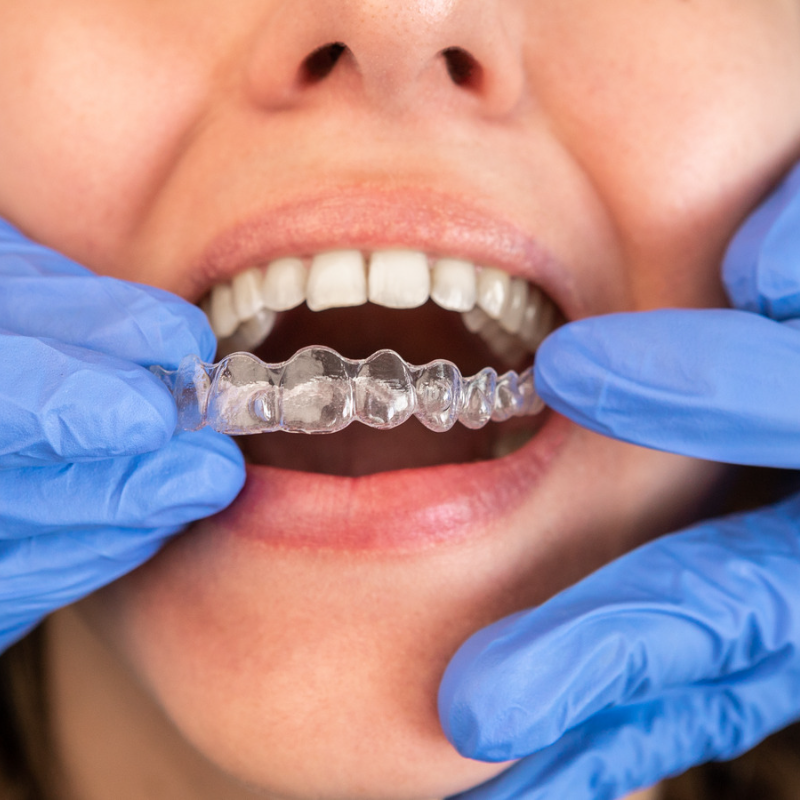 Smile Design By Issa Castro Doctors is a top-ranked Invisalign Provider in Cali, Colombia.