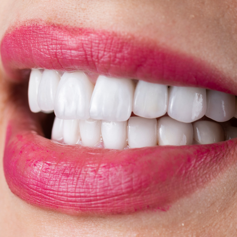 Porcelain Veneers in colombia | smile design by doctor Issa Castro Doctors | dental tourism in cali colombia |Porcelain Veneers by Issa castro doctors