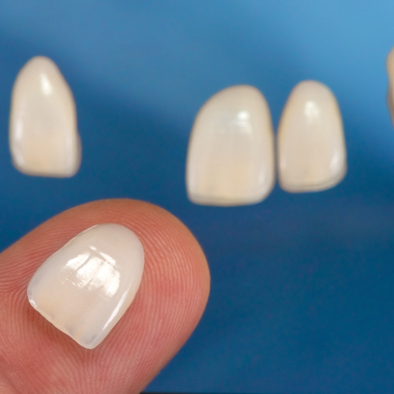 How Much Do Porcelain Veneers Cost? Why is it Cheaper to Get Them Done in Colombia.