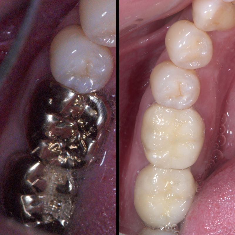 Dental Bridges and dental Crowns