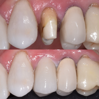 Dental Bridges and dental Crowns