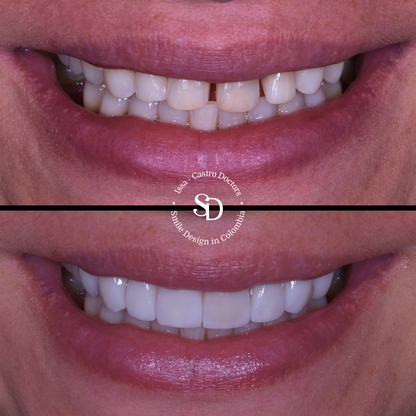 Porcelain Veneers in colombia | smile design by doctor Issa Castro Doctors | dental tourism in cali colombia |Porcelain Veneers by Issa castro doctors