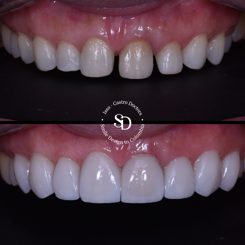 Smile Design Porcelain Veneers Smiledesignincolombia