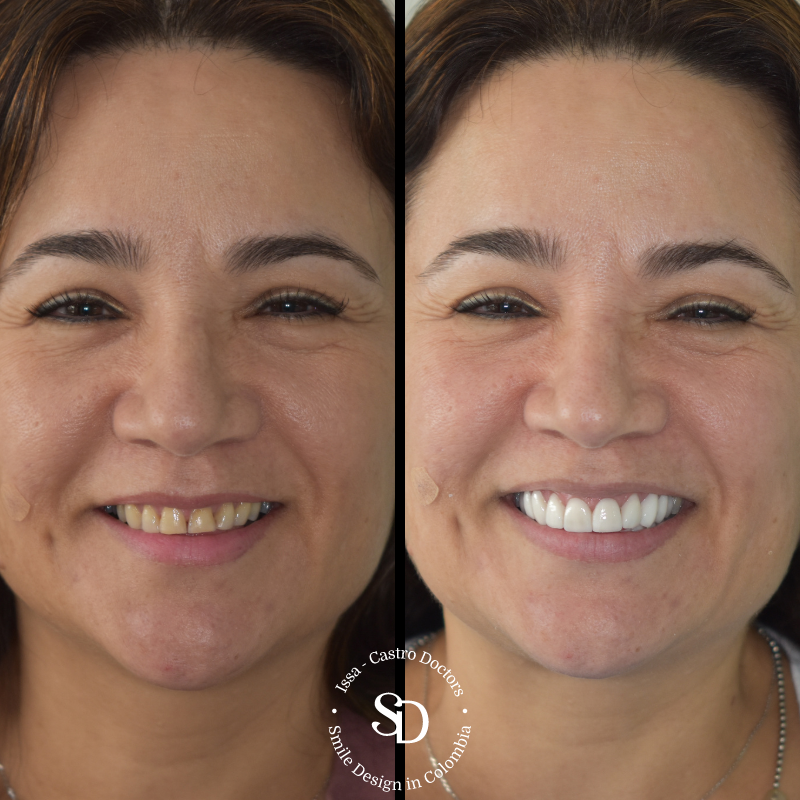 Porcelain Veneers in colombia | smile design by doctor Issa Castro Doctors | dental tourism in cali colombia |Porcelain Veneers by Issa castro doctors
